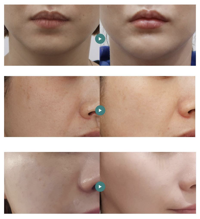 rejuran麗珠蘭水光針效果