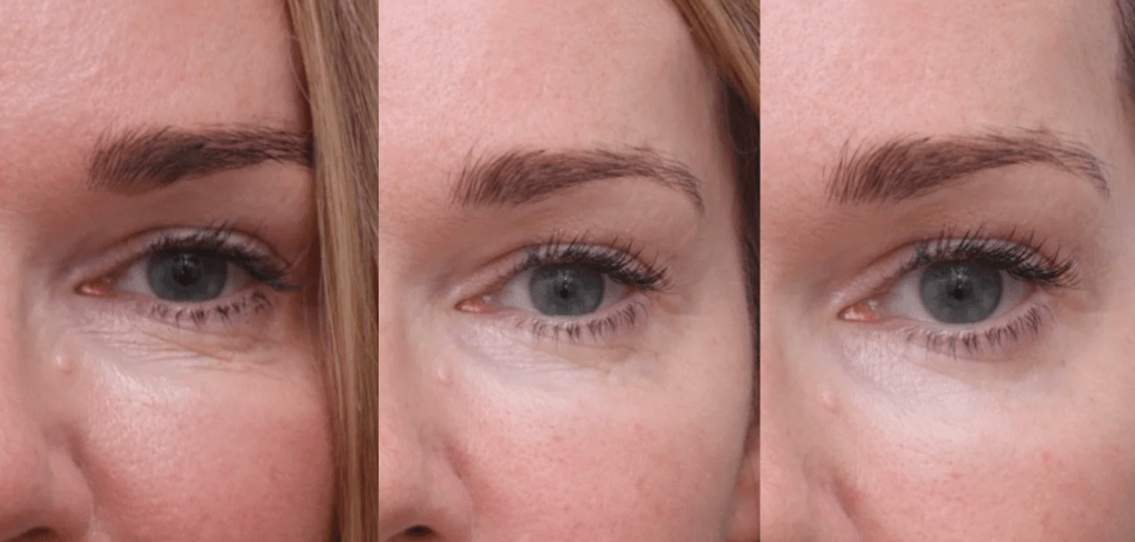 rejuran麗珠蘭水光針效果