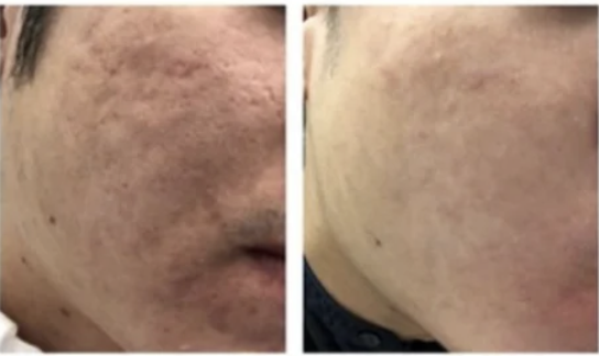 rejuran麗珠蘭水光針效果